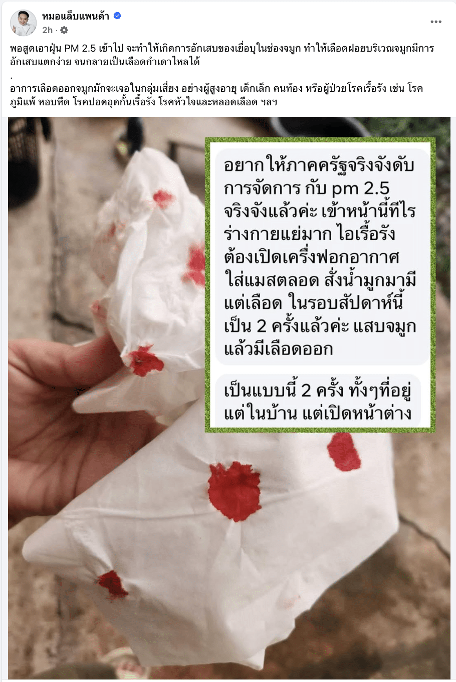 หมอแล็บแพนด้า แชร์ภาพ การอักเสบของเยื่อบุในช่องจมูก หลังสูด PM 2.5 